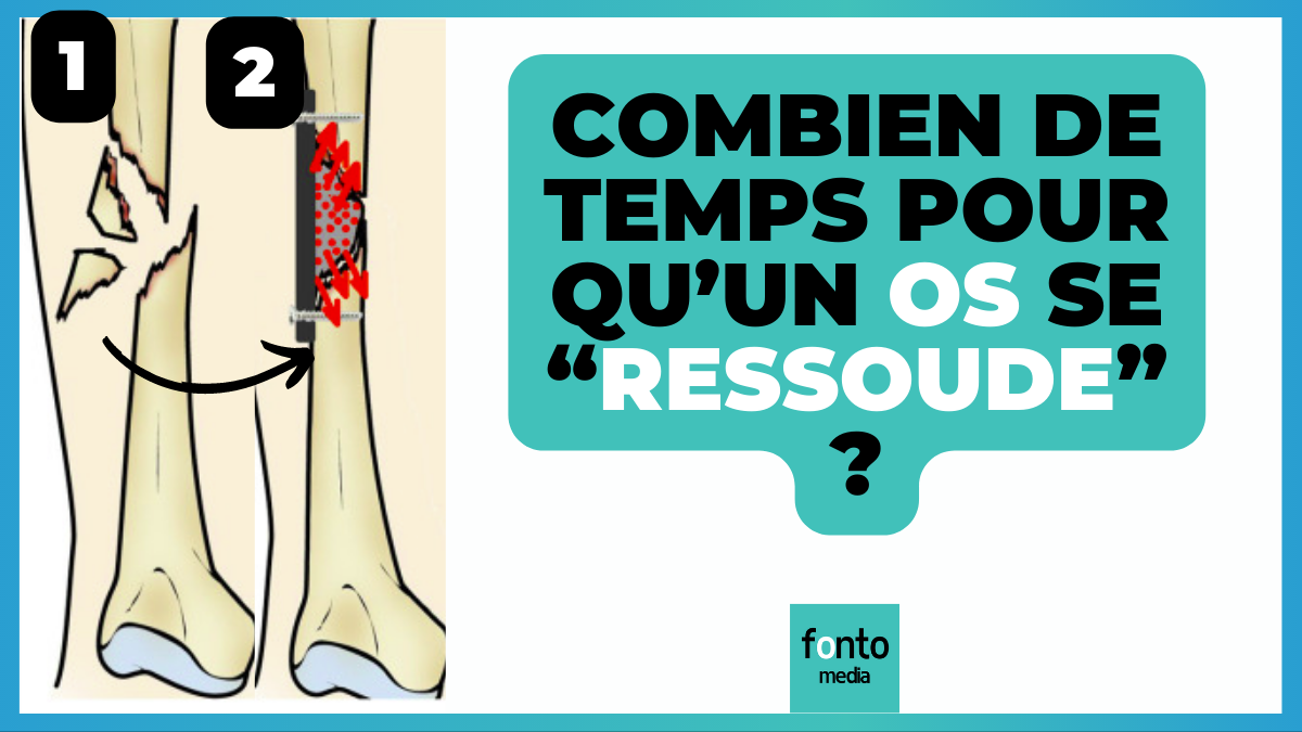 Combien de temps pour qu'un os se ressoude — free download
