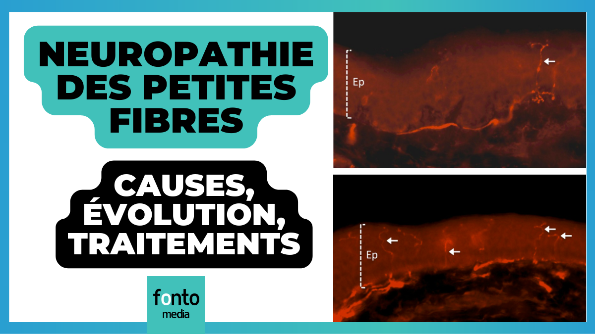 Neuropathie des petites fibres les études