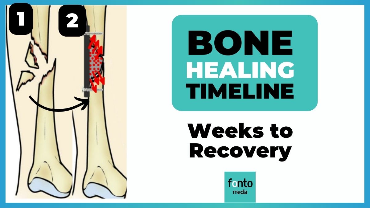 Bone Healing Timeline: Weeks to Recovery