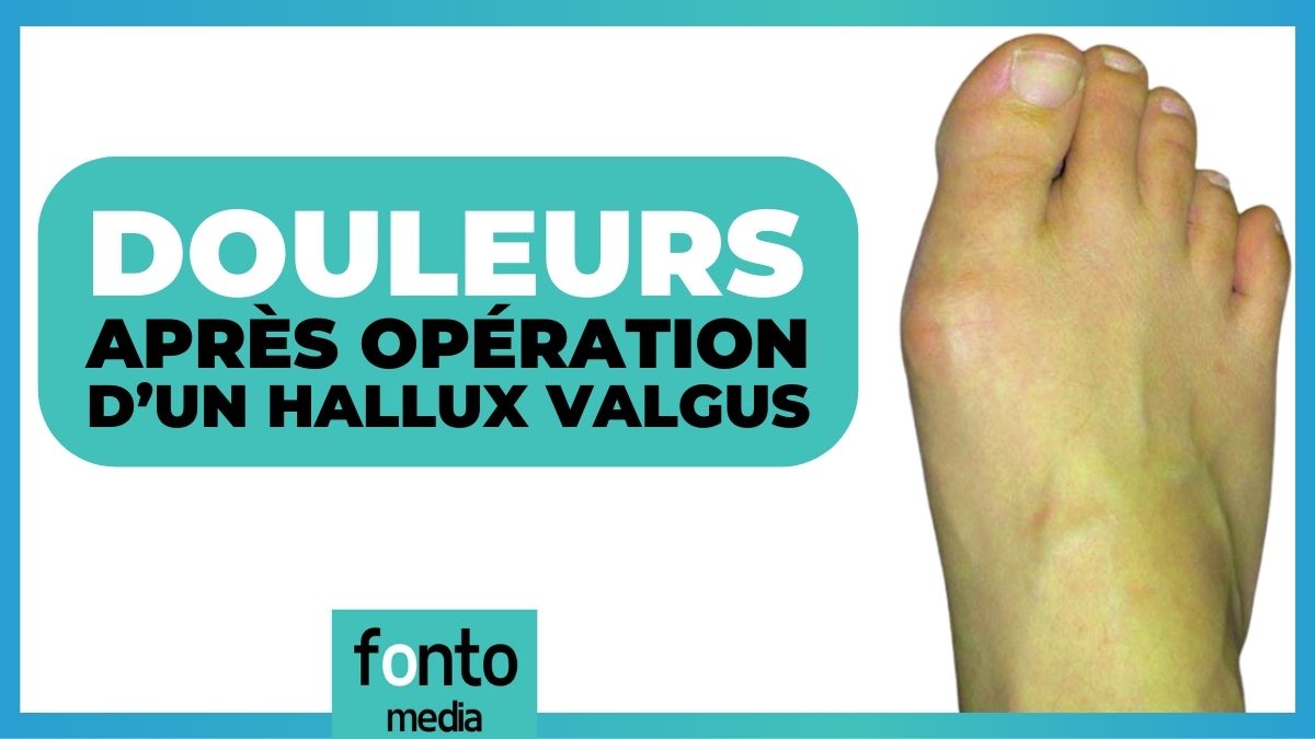 5 faits sur les douleurs après opération de l'hallux valgus — free download